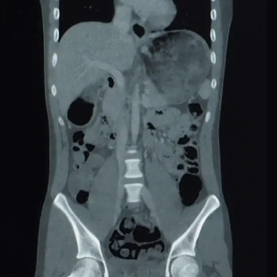 CECT Upper & Lower Abdomen
